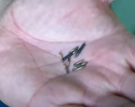 Médico implanta microchips en sus manos para una vida más fácil  