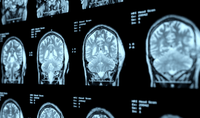 tomografía del cerebro