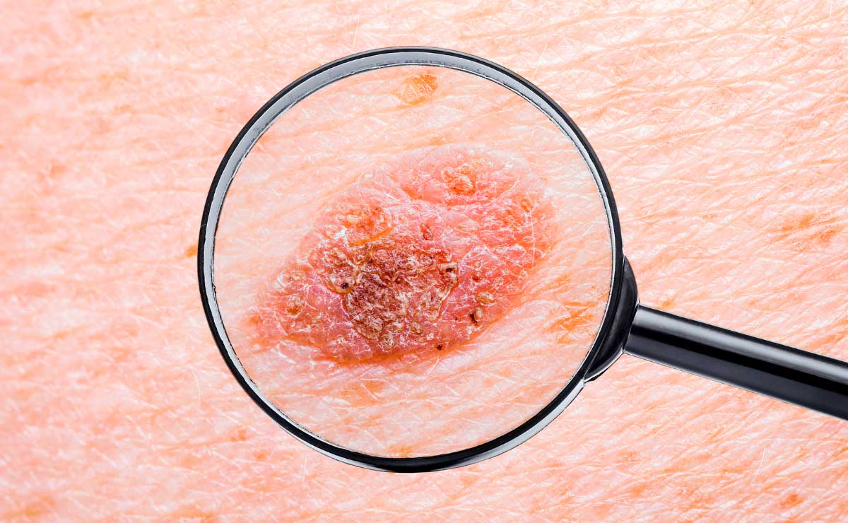 Síntomas y signos del cáncer de piel