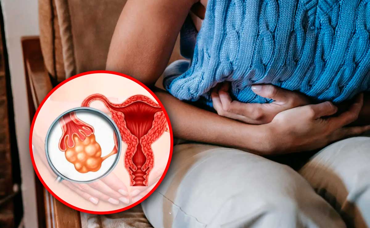 ¿Qué es el Síndrome de Ovario Poliquístico?